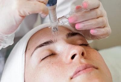 Microneedling with infusion treatment at Bewitching Cosmetic Clinic